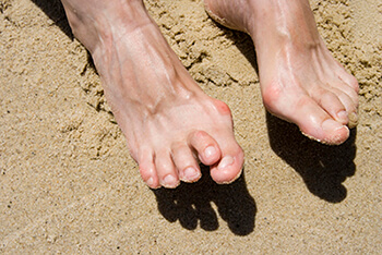 Hammertoes & Mallet Toes treatment in the Salisbury, NC 28144; Charlotte, NC 28215; Concord, NC 28025 areas